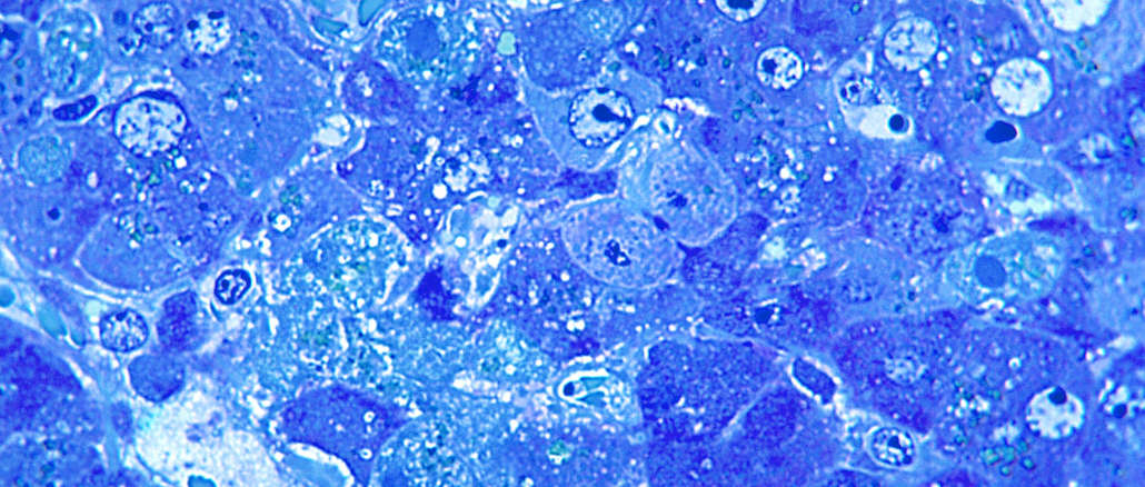 Europe : hausse des infections chroniques à l’hépatite B depuis 10 ans