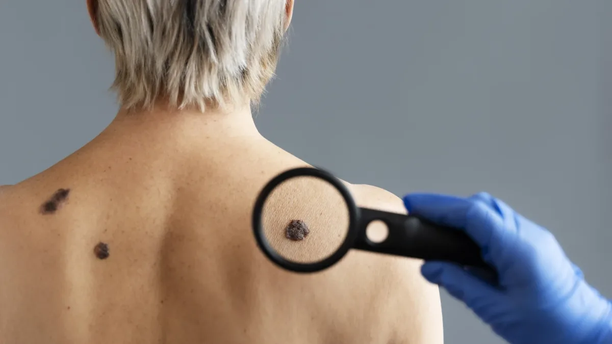 Cancer de la peau et UV au travail : quels métiers entreraient dans le tableau de maladie professionnelle proposé par l’Anses