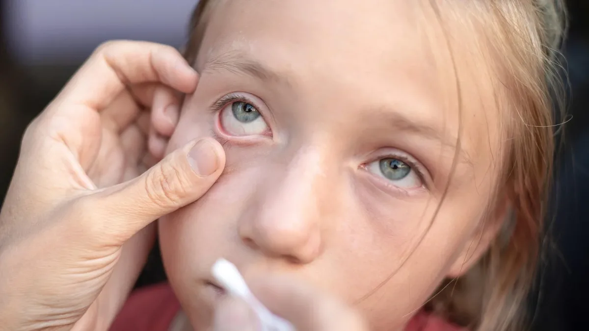 Pénurie de Verkazia : jusqu’en décembre 2026, ce collyre est réservé aux enfants et adolescents